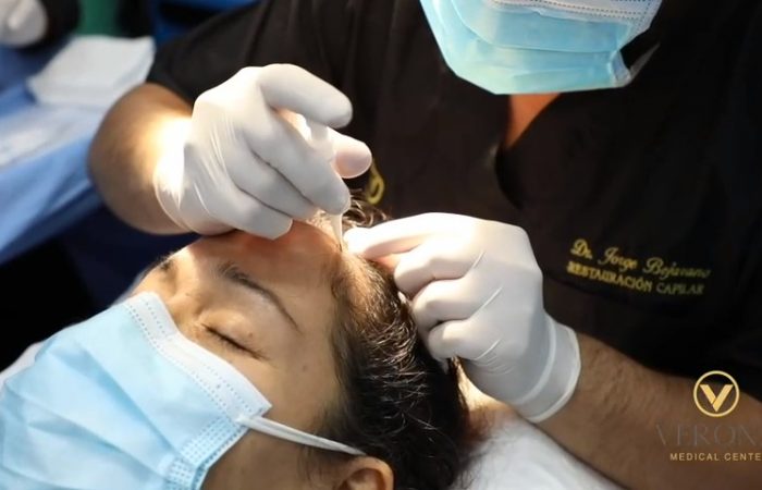 trasplante capilar3